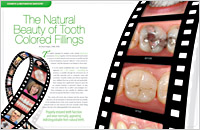 Tooth Colored Fillings - Dear Doctor Magazine